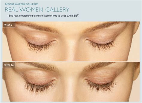 Why Choose Latisse Over Other Eyelash Growth Products The Skin Clinic North Scottsdale