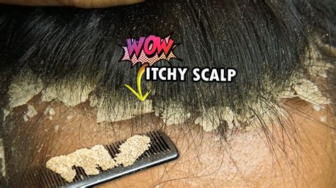 Scratching Itchy Dry Scalp Natural Hair 509 Youtube