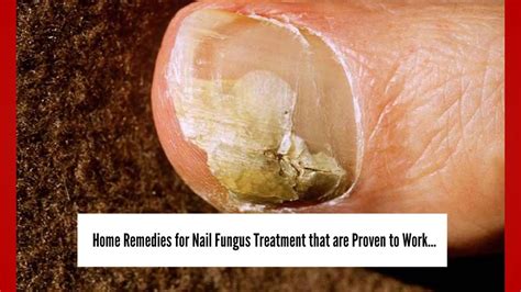 Nail Fungus Treatment 3 Home Remedies For Nail Fungus Youtube