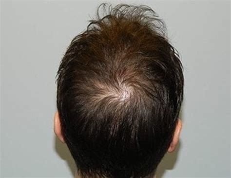Patient 133066295 Hair Transplant Smartgraft Before And After Photos