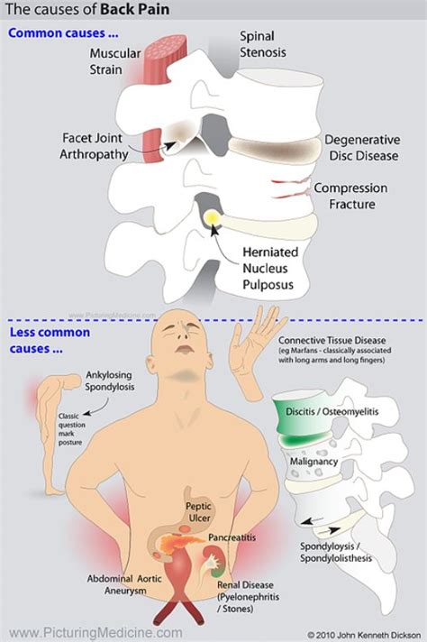 The Causes Of Lower Back Pain Illustrated Differential Grepmed