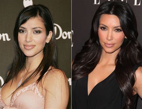 kim kardashian before and after surgery