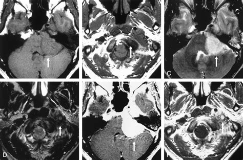 Different Signal Intensities Between Intra And Extracranial Components In Jugular Foramen