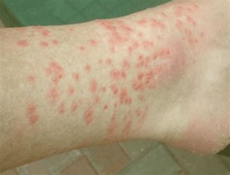 Here we look at how to avoid getting bitten as well as how to recognize and treat any existing bites. HOW TO TACKLE WITH UNKNOWN INSECT BITES - Harcourt Health