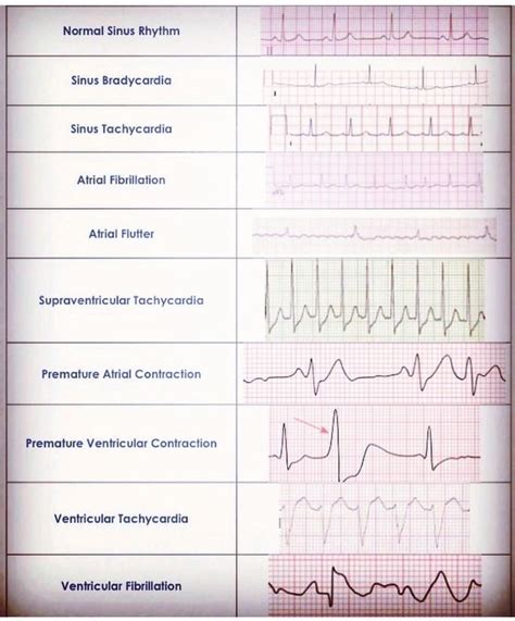 Ecg Tests And Answers