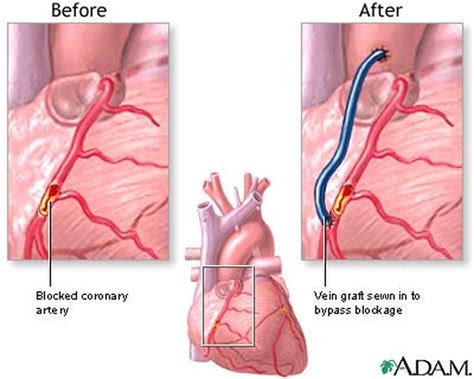 Quadruple Bypass Heart Surgery Process And Recovery Bypass Surgery