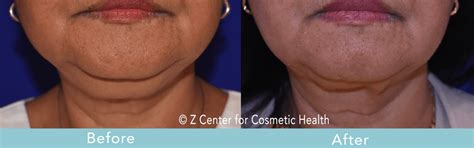 Coolsculpting Double Chin Before And After 3 Zcosmetic Health
