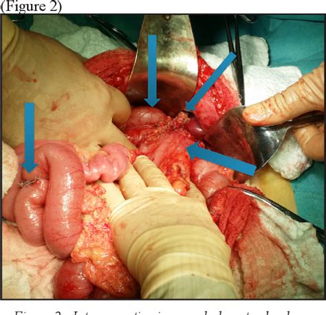 Pdf Gallstone Ileus Caused By A Cholecysto Duodeno Colic Fistula