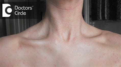 Anxiety Rash On Chest And Neck