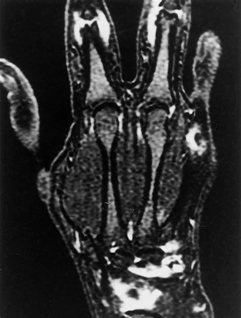 Contrast Enhanced Mr Angiography Of The Hand Radiographics