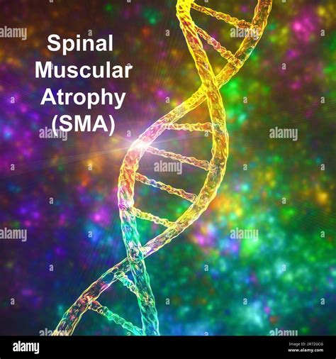 Spinal Muscular Atrophy Sma A Genetic Neuromuscular Disorder With