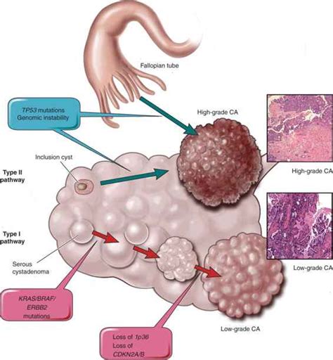 Epithelial Ovarian Cancers Low Malignant Potential And Non Serous Ovarian Histologies Obgyn Key