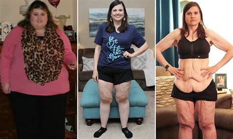 Amazing Stories Around The World Woman Who Refused To Have Gastric Bypass Surgery Lost Lbs