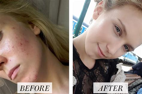 Womans Before And After Accutane Photos Go Viral On Reddit Allure