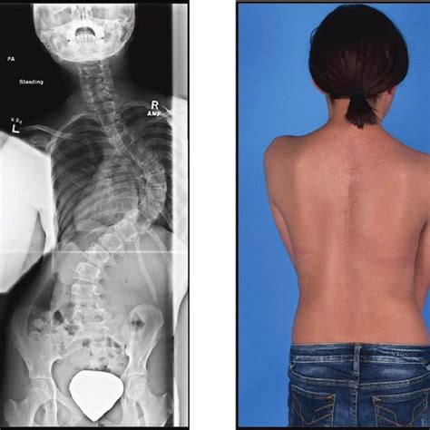 Adolescent Idiopathic Scoliosis In A Female Patient Photograph And