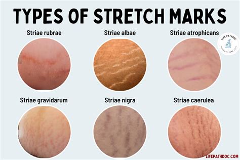Types Of Stretch Marks With Pictures