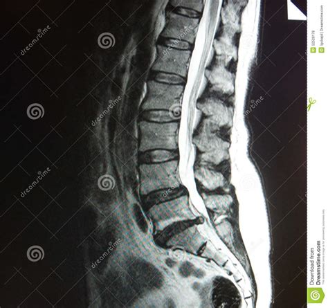 Mri Of Lumbar Spine Stenosis Stock Photo Image 52528178