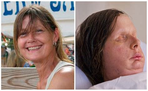 Chimp Attack Woman’s Body Rejecting Face Transplant
