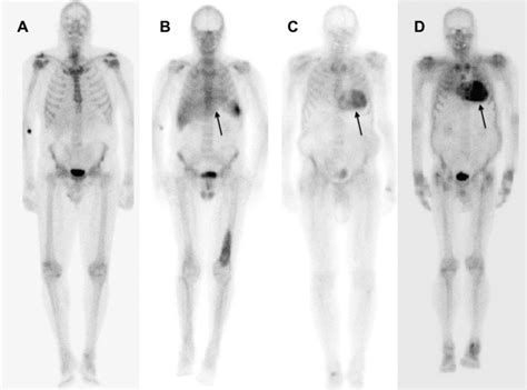 The Utility Of MTc DPD Scintigraphy In The Diagnosis Of Cardiac Amyloidosis An Australian
