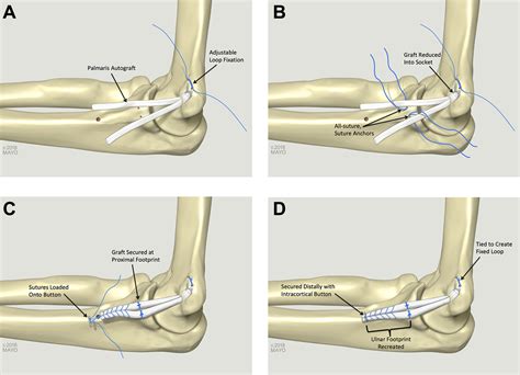 Reconstruction Of The Medial Ulnar Collateral Ligament Of The Elbow Biomechanical Comparison Of