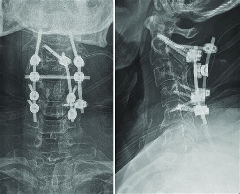 Anteroposterior And Lateral Radiographs In The Immediate Post Operative