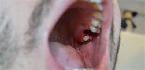 What to expect, causes for extraction, and more. How Long Does It Take For My Wisdom Teeth Holes To Heal ...