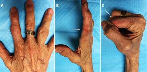 Aahs Long Term Successful Wrist And Finger Joint Arthroplasty Using