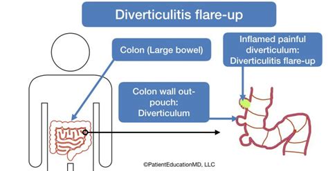 Symptoms Of Diverticulitis Flare Up Patienteducationmd