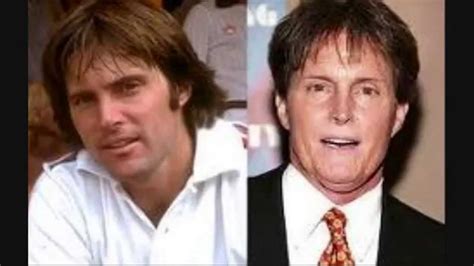 Celebrity Plastic Surgery Before And After Faceliftjaw