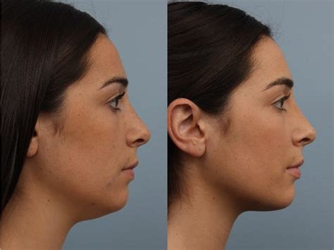 What Non Invasive Treatments Work Best For Double Chin Removal Women