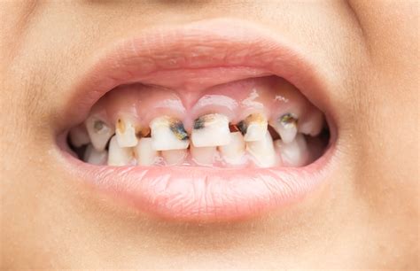 歯科治療で一番多い虫歯の原因とは？ コラム 福岡市博多区の歯医者ならむらつ歯科クリニック