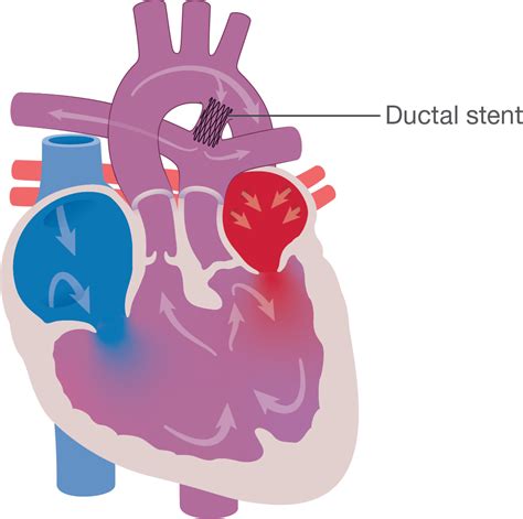 Double Inlet Left Ventricle Dilv Little Hearts Matter