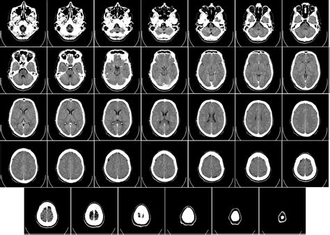 Ct Head Open Med School