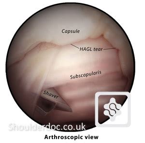 Listen to hagl online and get recommendations on similar music. HAGL Injury | ShoulderDoc