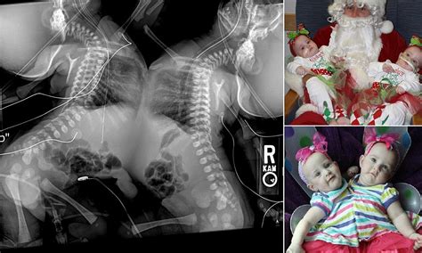 Conjoined Twins X Ray Shows The Complicated Procedure Facing Doctors Who Separated Allison And