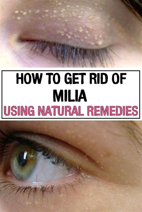 How To Get Rid Of Milia At Home Fast