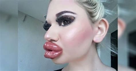 A Real Life Barbie Goes Overboard With Lip Filler Injections