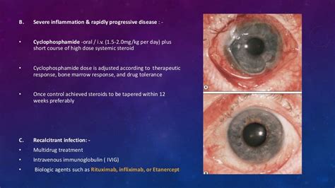 Ocular Cicatricial Pemphigoid Stevens Johnson Syndrome Toxic Epider