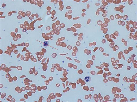 Normocytic Anemia Sickle Cell Anemia Sickle Cell Disease Lecturio