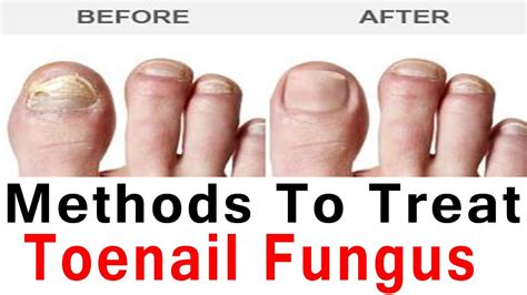 Toenail Fungus Medication And Treatment Home Remedies
