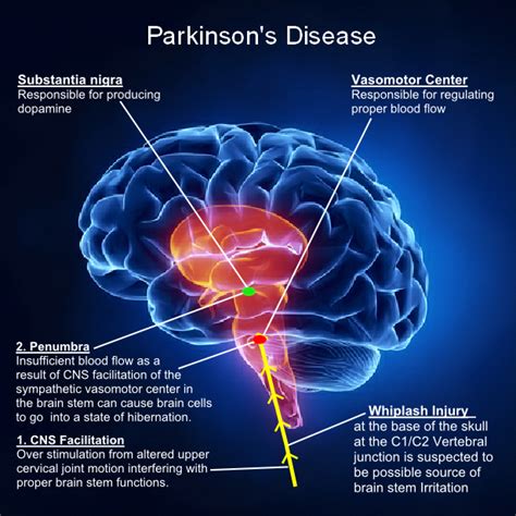 Parkinsons Disease Area Of Brain Affected Minimalistisches Interieur