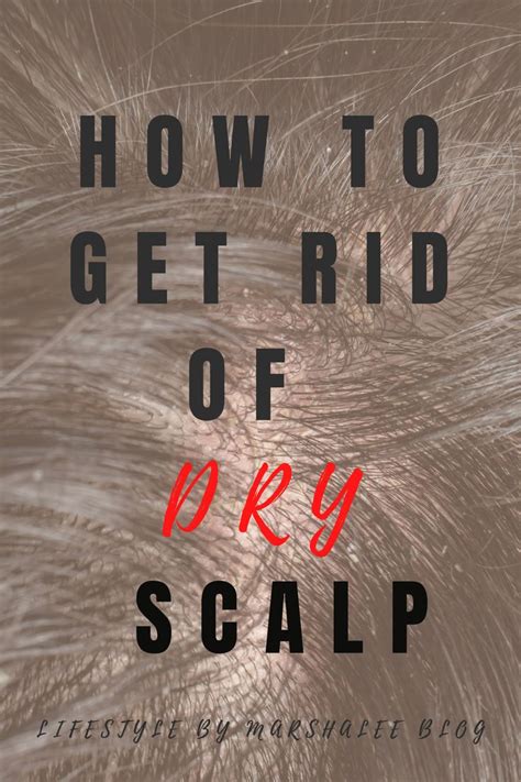 How To Get Rid Of Dry Scalp Dry Scalp Remedy Dry Scalp Treatment Diy