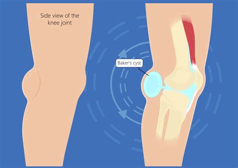 Pain Behind Knee What Should You Do Sport Doctor London