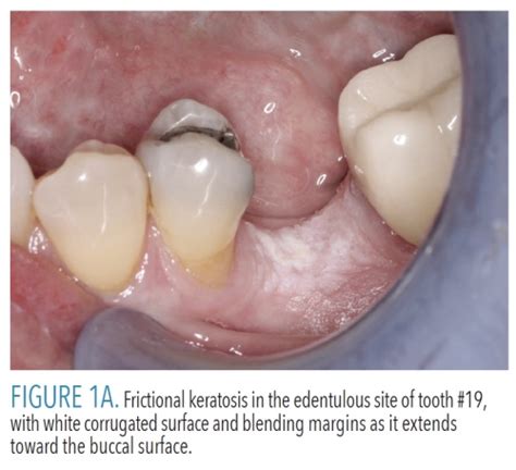 Diagnostic Tips For Benign White Oral Mucosal Lesions Dimensions Of