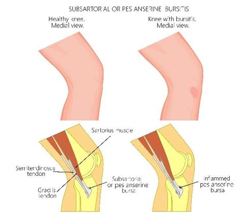 Pes Anserine Bursitis Knee Pain Movement And Wellbeing Clinic