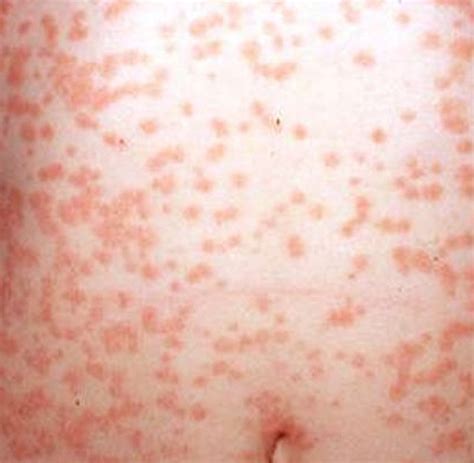 How To Treat Guttate Psoriasis Dorothee Padraig South