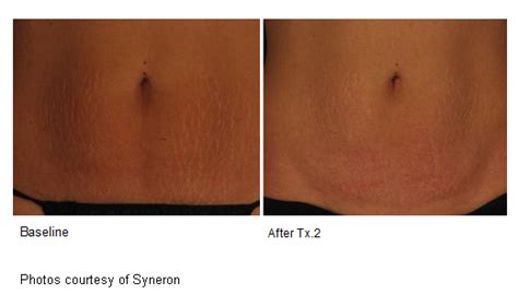 Scar Removal Treatments In Nyc Michele S Green Md