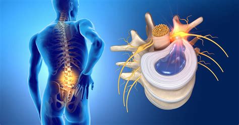 Relieve Herniated Disc Pain With Physical Therapy Oc Sports And Rehab
