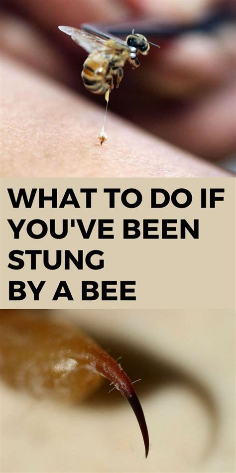 What To Do If Youve Been Stung By A Bee Remedies For Bee Stings What Helps Bee Stings Bee