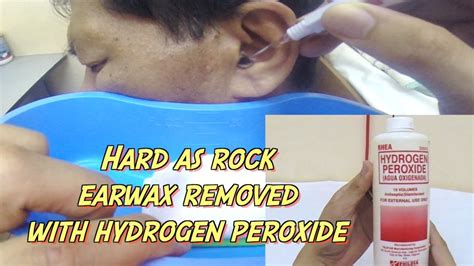 To reduce the need for ear cleaning, scheduling ear cleaning weekly or. Hard as Rock Earwax Removal using Hydrogen Peroxide - YouTube